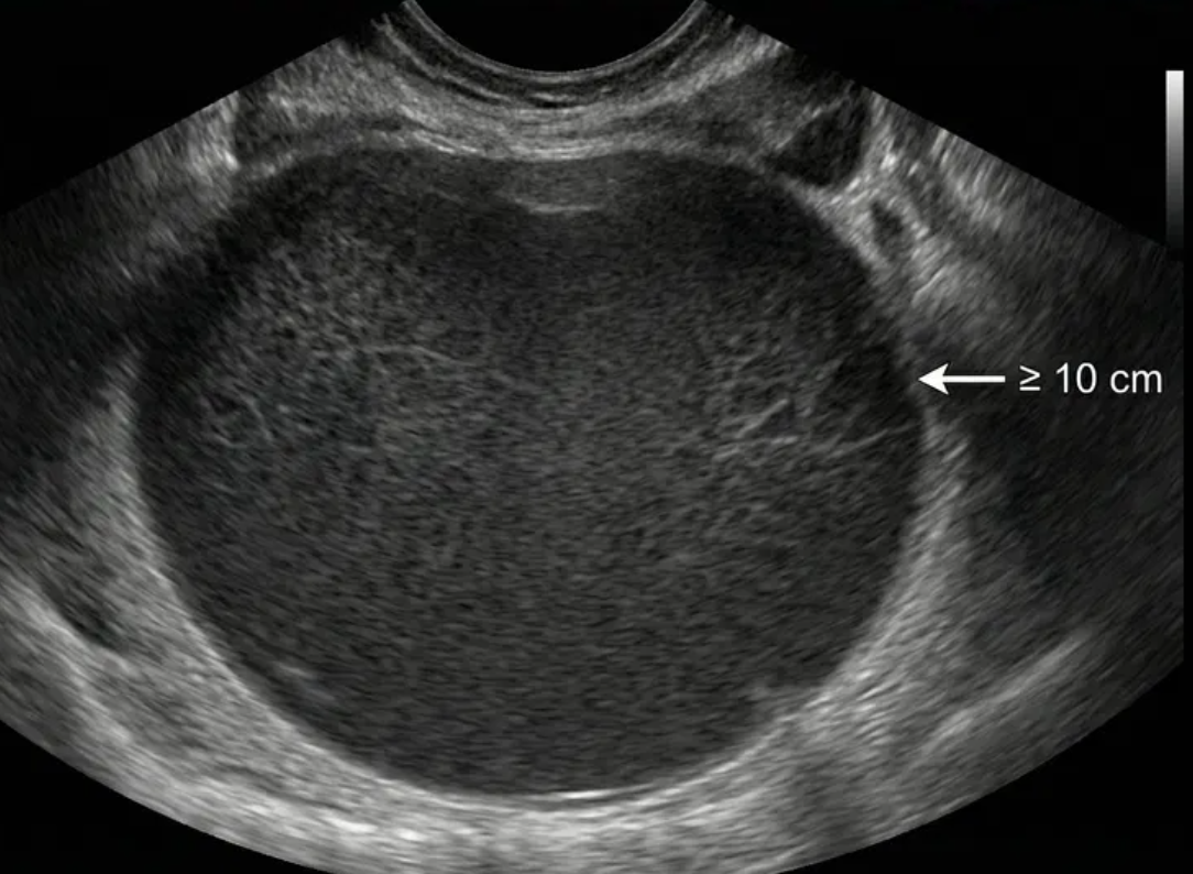 Illustration: Typical hemorrhagic cyst ≥ 10 cm